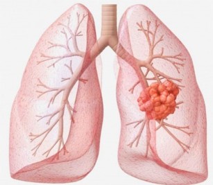 lung disease